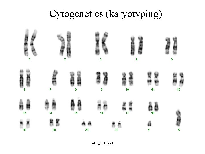Cytogenetics (karyotyping) AML_2014 -05 -28 