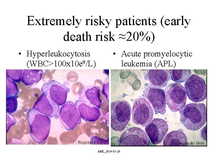 Extremely risky patients (early death risk ≈20%) • Hyperleukocytosis (WBC>100 x 10 e 9/L)