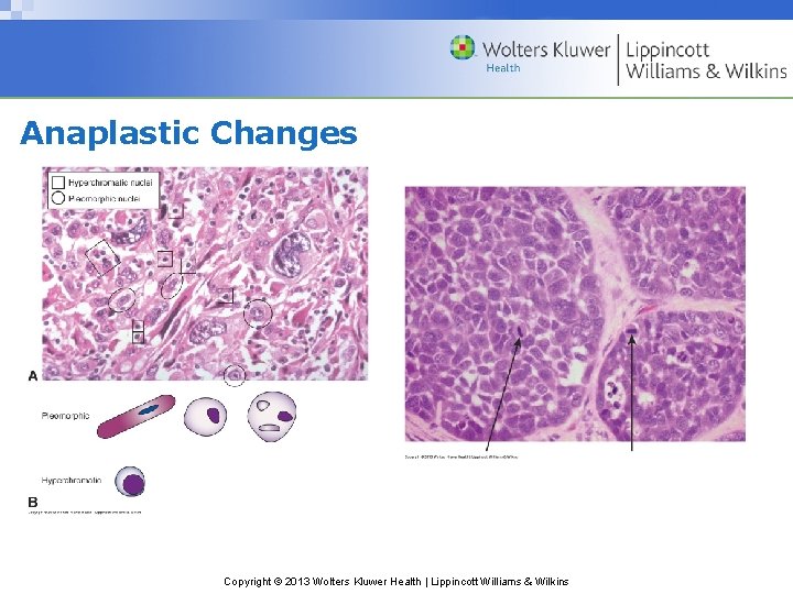 Anaplastic Changes Copyright © 2013 Wolters Kluwer Health | Lippincott Williams & Wilkins 