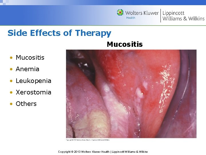 Side Effects of Therapy Mucositis • Anemia • Leukopenia • Xerostomia • Others Copyright