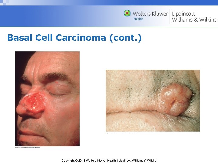 Basal Cell Carcinoma (cont. ) Copyright © 2013 Wolters Kluwer Health | Lippincott Williams