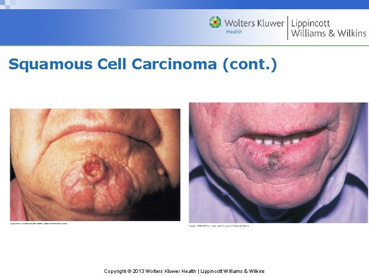 Squamous Cell Carcinoma (cont. ) Copyright © 2013 Wolters Kluwer Health | Lippincott Williams