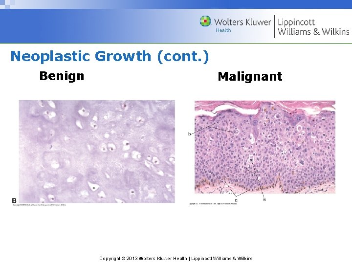 Neoplastic Growth (cont. ) Benign Malignant Copyright © 2013 Wolters Kluwer Health | Lippincott