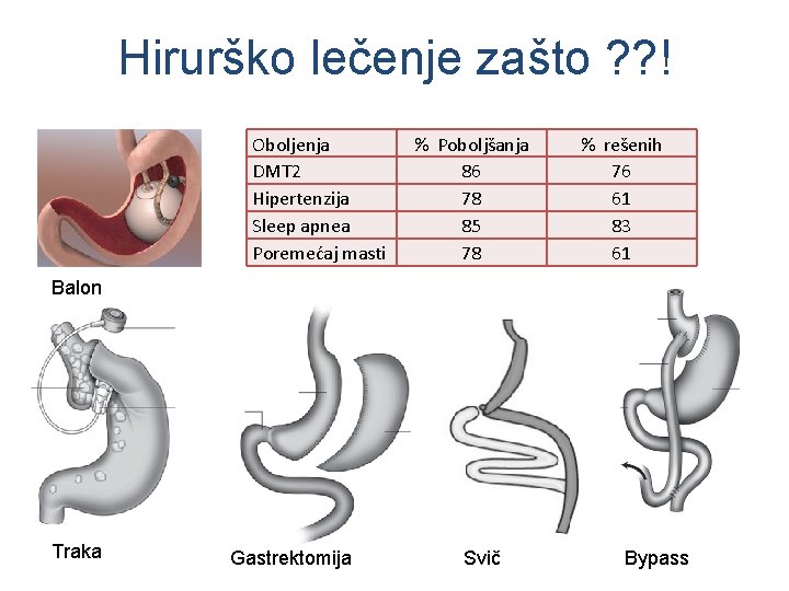 Hirurško lečenje zašto ? ? ! Oboljenja DMT 2 Hipertenzija Sleep apnea Poremećaj masti