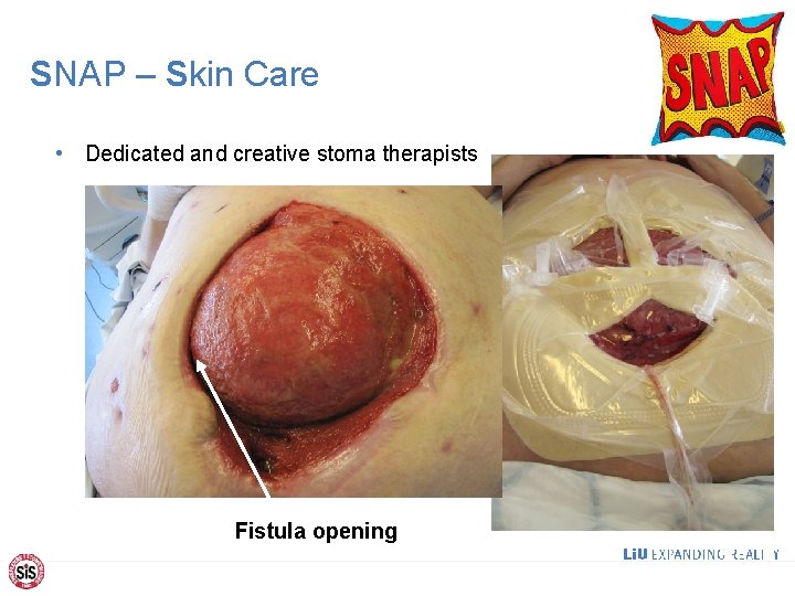 SNAP – Skin Care • Dedicated and creative stoma therapists Fistula opening 15 
