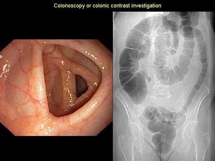 Colonoscopy or colonic contrast investigation 19 