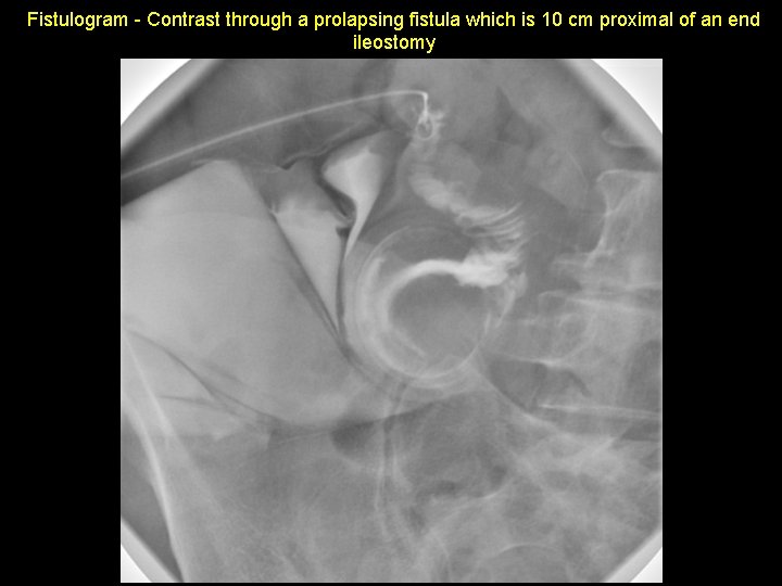 Fistulogram - Contrast through a prolapsing fistula which is 10 cm proximal of an