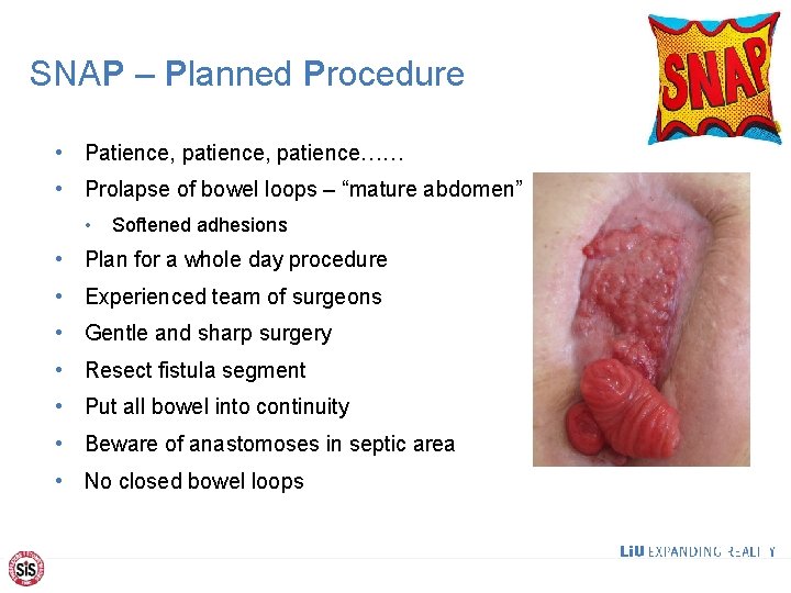 SNAP – Planned Procedure • Patience, patience…… • Prolapse of bowel loops – “mature