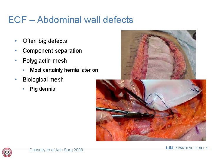 ECF – Abdominal wall defects • Often big defects • Component separation • Polyglactin