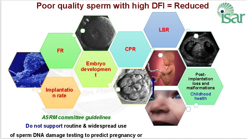 Poor quality sperm with high DFI = Reduced LBR CPR FR Embryo developmen t