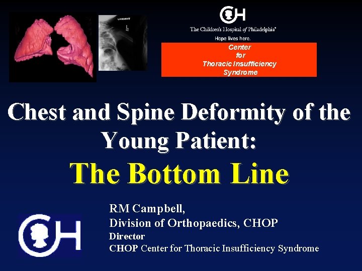 Center for Thoracic Insufficiency Syndrome Chest and Spine Deformity of the Young Patient: The