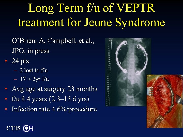 Long Term f/u of VEPTR treatment for Jeune Syndrome O’Brien, A, Campbell, et al.