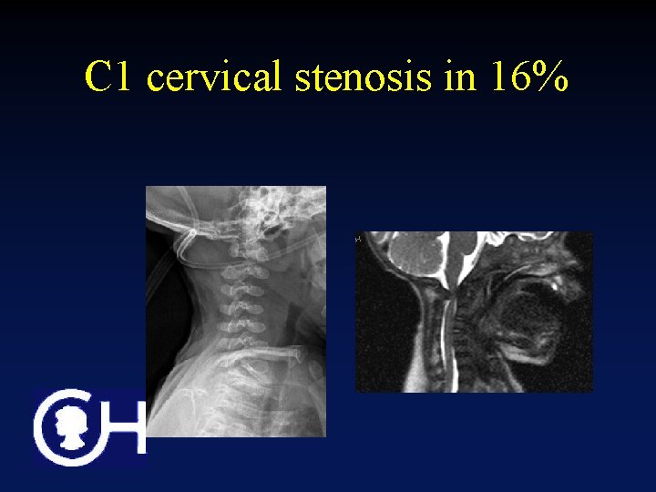 C 1 cervical stenosis in 16% 