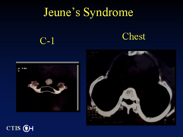 Jeune’s Syndrome C-1 CTIS Chest 