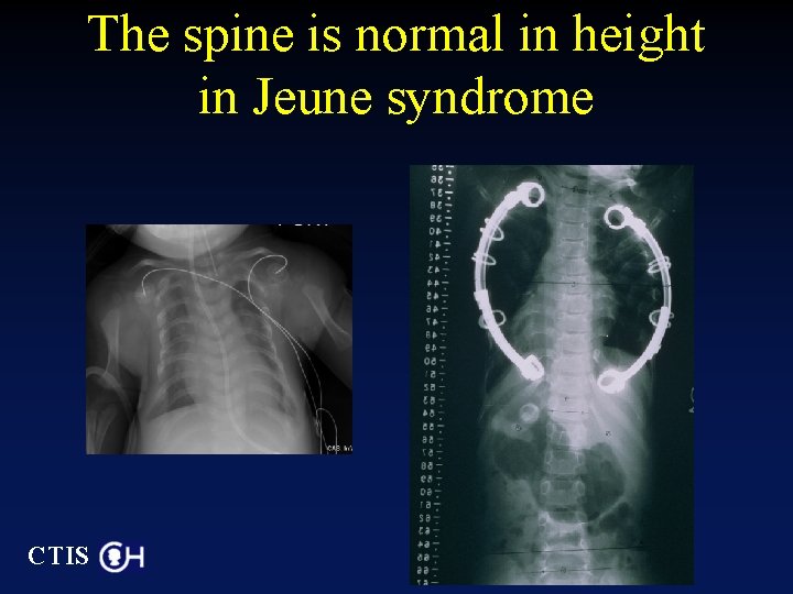 The spine is normal in height in Jeune syndrome CTIS 