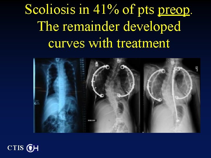 Scoliosis in 41% of pts preop. The remainder developed curves with treatment CTIS 