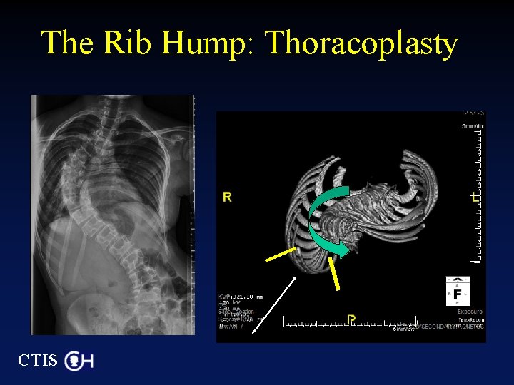 The Rib Hump: Thoracoplasty CTIS 