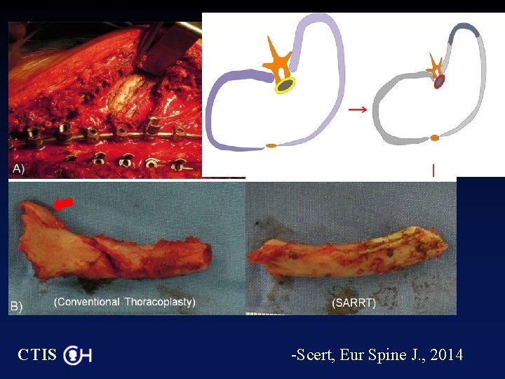 CTIS -Scert, Eur Spine J. , 2014 