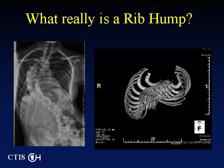 What really is a Rib Hump? CTIS 