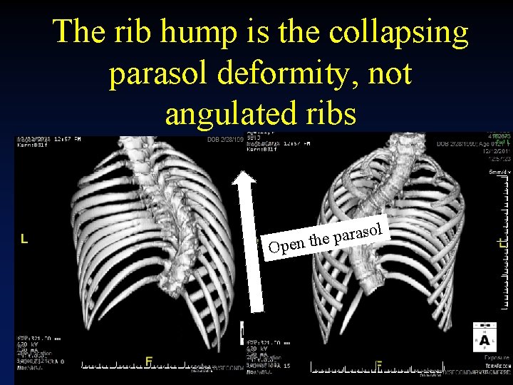 The rib hump is the collapsing parasol deformity, not angulated ribs l so a