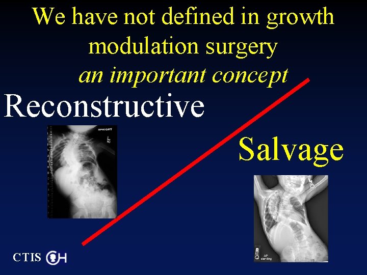 We have not defined in growth modulation surgery an important concept Reconstructive Salvage CTIS