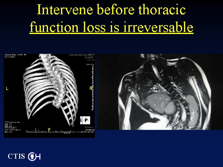 Intervene before thoracic function loss is irreversable CTIS 