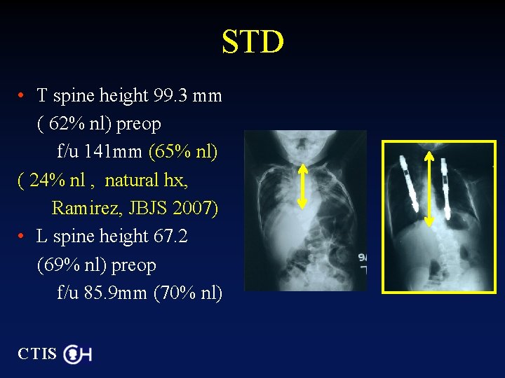 STD • T spine height 99. 3 mm ( 62% nl) preop f/u 141