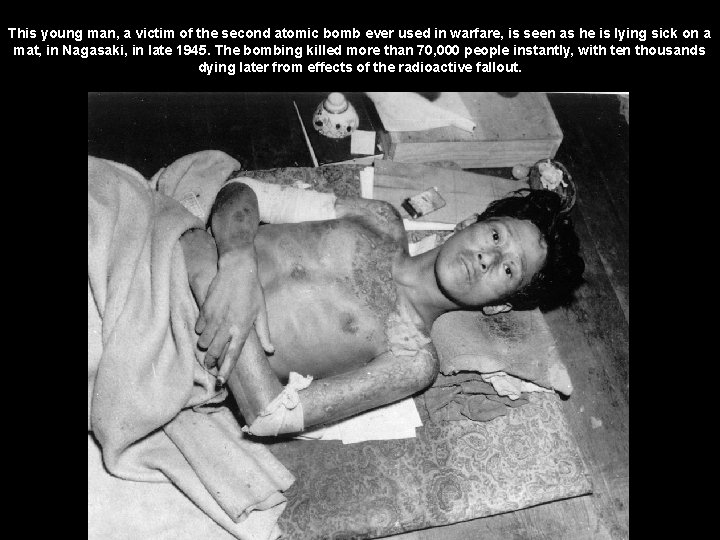 This young man, a victim of the second atomic bomb ever used in warfare,