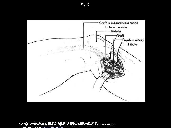 Fig. 5 Journal of Vascular Surgery 1987 6119 -123 DOI: (10. 1067/mva. 1987. avs