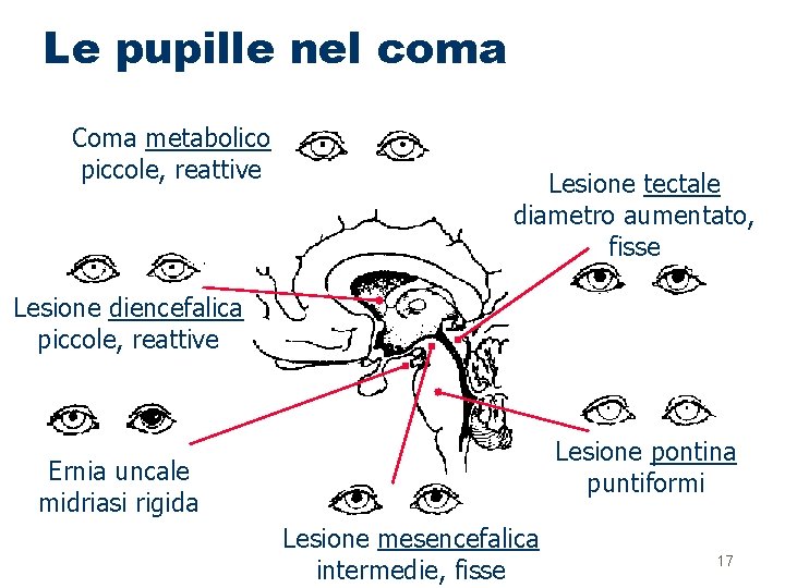 Le pupille nel coma Coma metabolico piccole, reattive Lesione tectale diametro aumentato, fisse Lesione