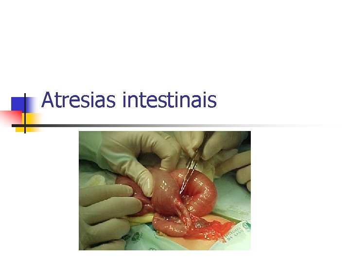 Atresias intestinais 