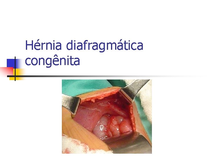 Hérnia diafragmática congênita 