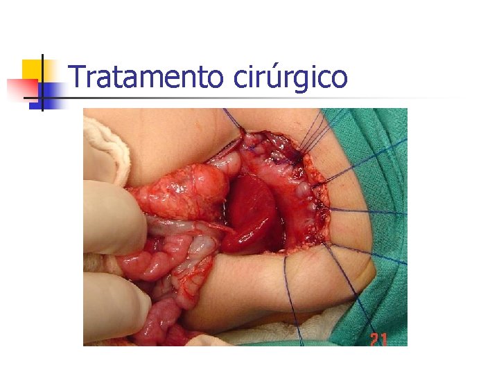Tratamento cirúrgico 