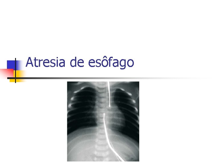 Atresia de esôfago 