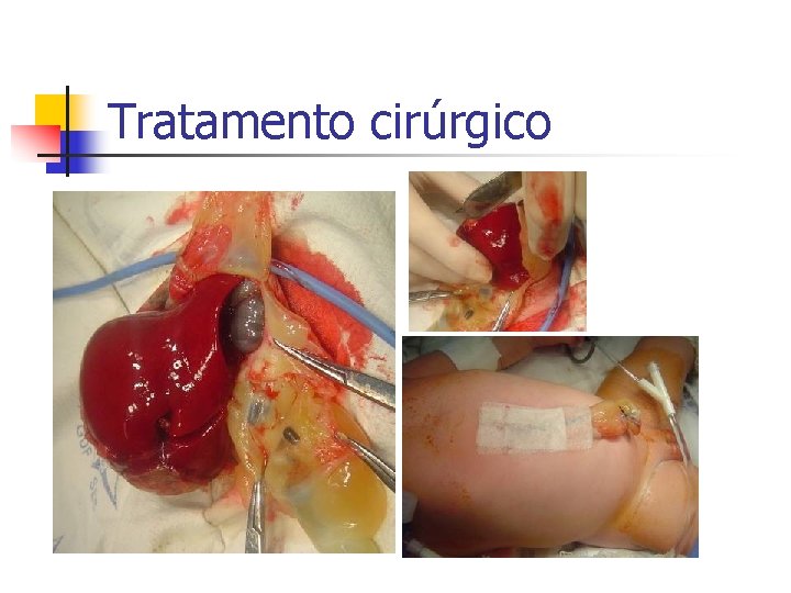 Tratamento cirúrgico 