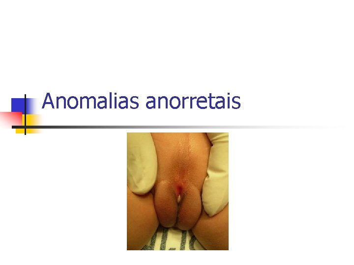 Anomalias anorretais 