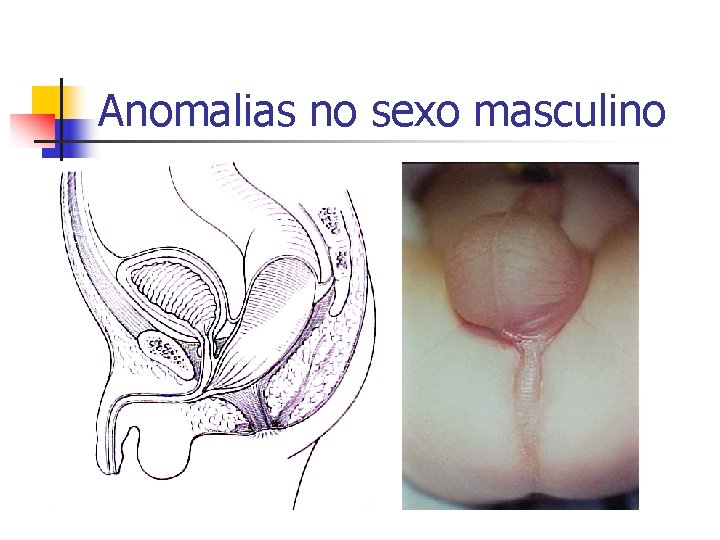 Anomalias no sexo masculino 