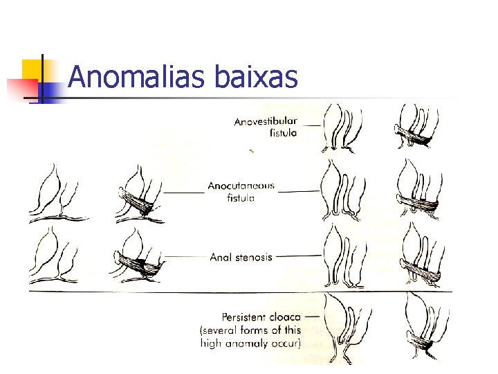 Anomalias baixas 