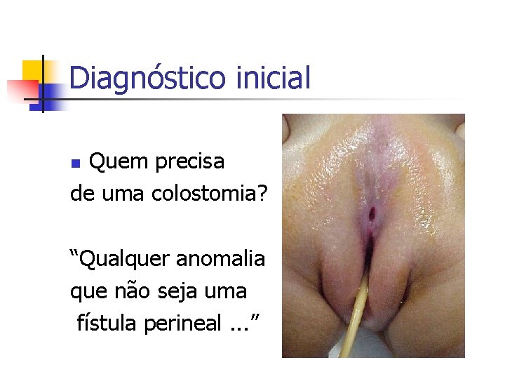 Diagnóstico inicial Quem precisa de uma colostomia? n “Qualquer anomalia que não seja uma