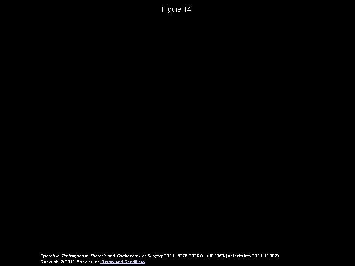 Figure 14 Operative Techniques in Thoracic and Cardiovascular Surgery 2011 16278 -292 DOI: (10.