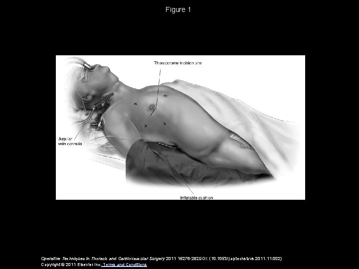 Figure 1 Operative Techniques in Thoracic and Cardiovascular Surgery 2011 16278 -292 DOI: (10.