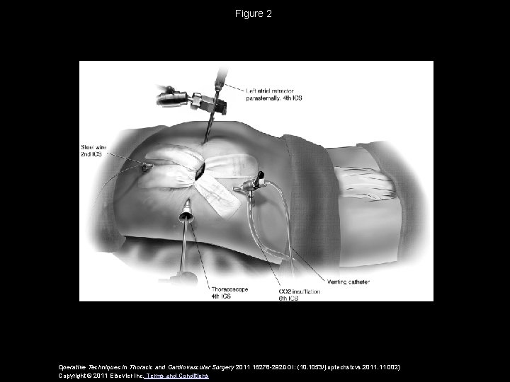 Figure 2 Operative Techniques in Thoracic and Cardiovascular Surgery 2011 16278 -292 DOI: (10.