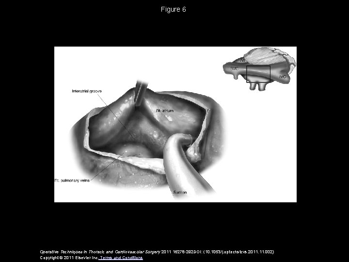 Figure 6 Operative Techniques in Thoracic and Cardiovascular Surgery 2011 16278 -292 DOI: (10.