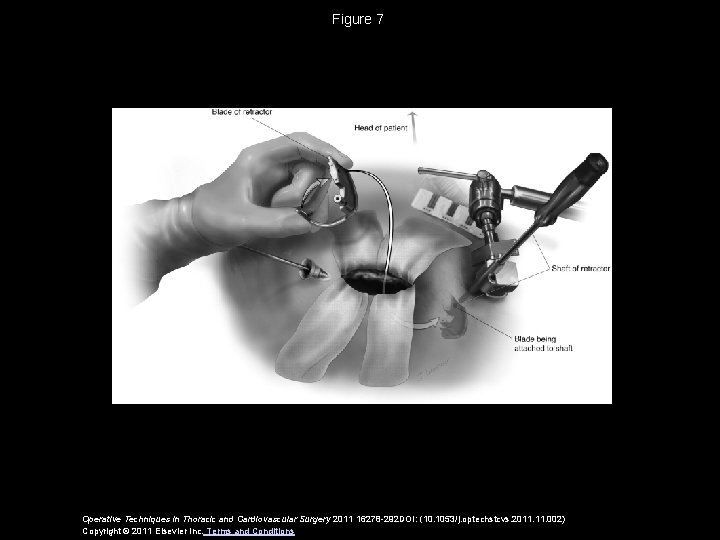 Figure 7 Operative Techniques in Thoracic and Cardiovascular Surgery 2011 16278 -292 DOI: (10.