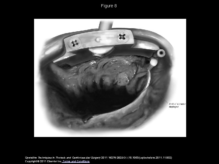 Figure 8 Operative Techniques in Thoracic and Cardiovascular Surgery 2011 16278 -292 DOI: (10.