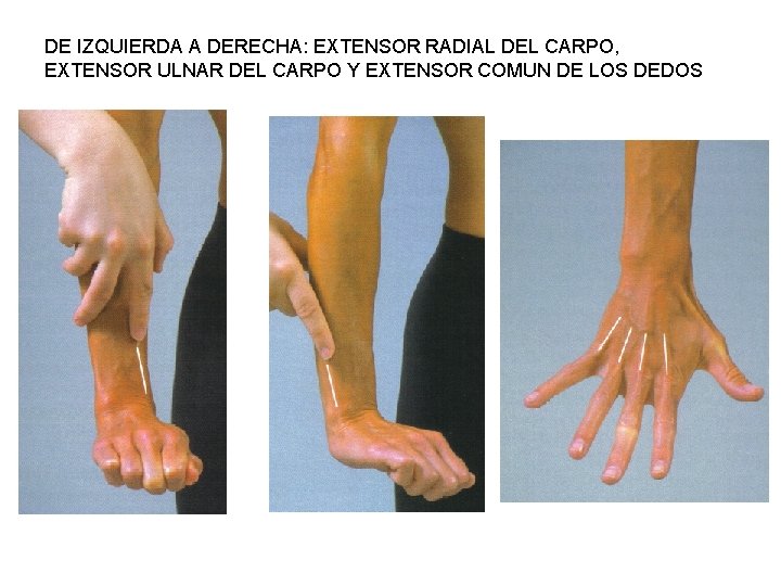 DE IZQUIERDA A DERECHA: EXTENSOR RADIAL DEL CARPO, EXTENSOR ULNAR DEL CARPO Y EXTENSOR