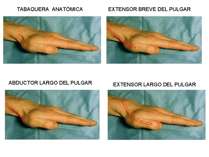 TABAQUERA ANATÓMICA ABDUCTOR LARGO DEL PULGAR EXTENSOR BREVE DEL PULGAR EXTENSOR LARGO DEL PULGAR