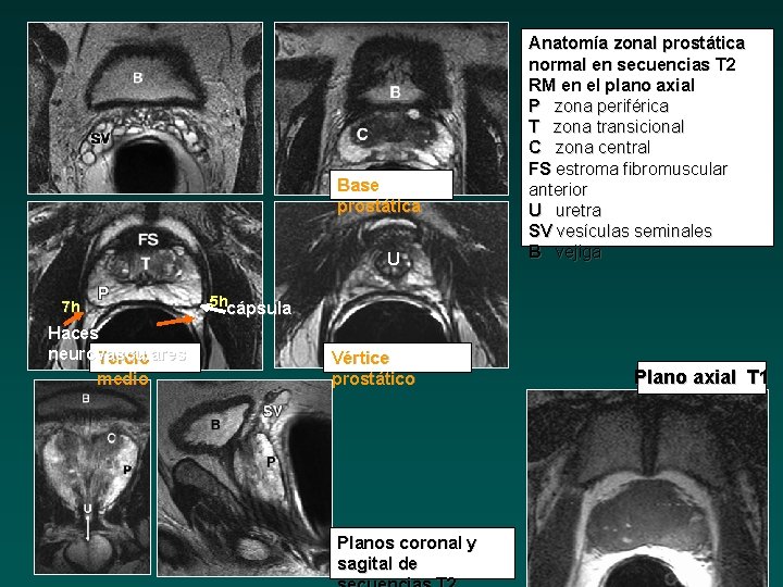 anatomia prostata rm
