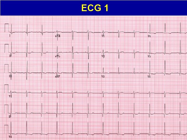 ECG 1 