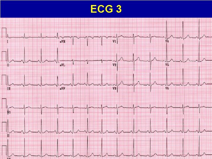 ECG 3 